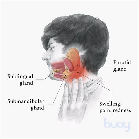 blocked prada gland|Parotid Duct Obstruction .